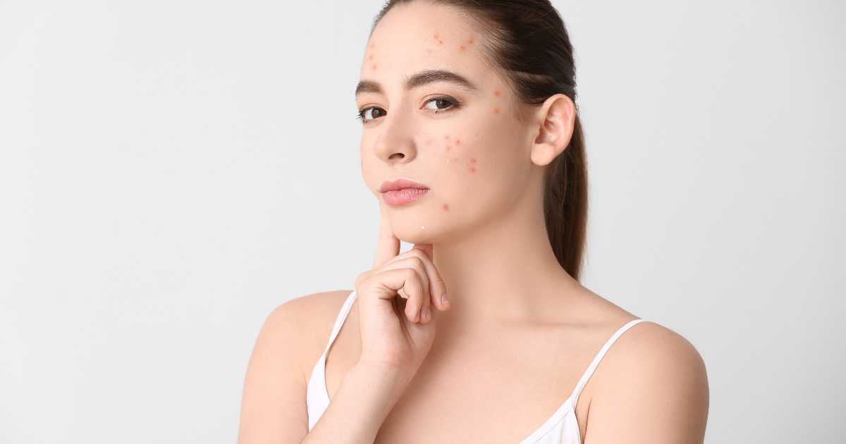 Investimento em Bem-Estar: A Melhor Solução para Combater a Acne e Melhorar sua Autoestima